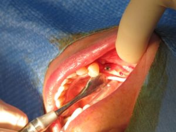 Cas d'implant réalisé au cabinet dentaire du docteur Assoun - St Jory - près de Toulouse