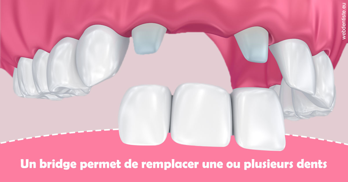 https://dr-assoun-catherine.chirurgiens-dentistes.fr/Bridge remplacer dents 2