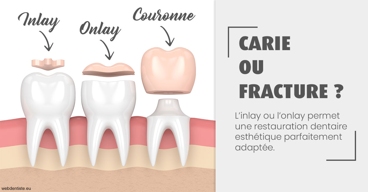 https://dr-assoun-catherine.chirurgiens-dentistes.fr/T2 2023 - Carie ou fracture 1