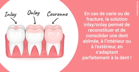 https://dr-assoun-catherine.chirurgiens-dentistes.fr/L'INLAY ou l'ONLAY 2