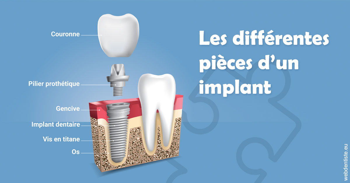 https://dr-assoun-catherine.chirurgiens-dentistes.fr/Les différentes pièces d’un implant 1